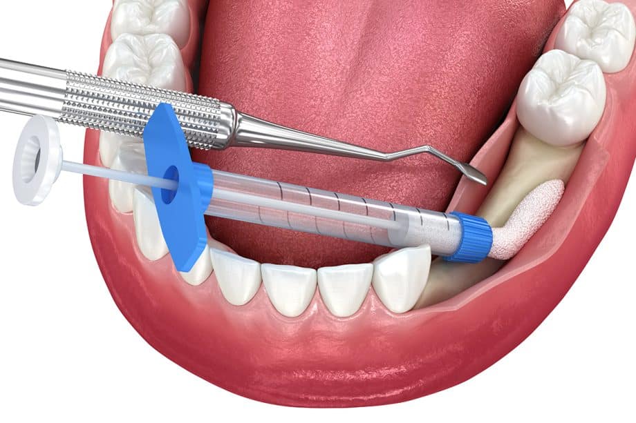 What is the Cost of Bone Grafting Before Dental Implants?